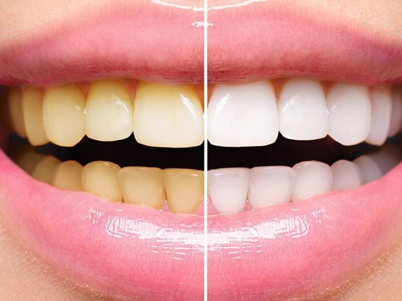 Răng sứ bị nhiễm màu có thể do uống thực phẩm có màu (Nguồn Internet)